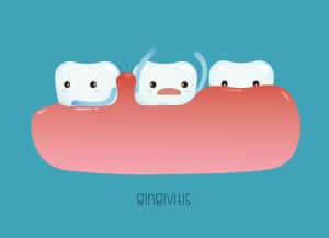 gingivitis