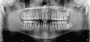 Should I Remove My Wisdom Teeth
