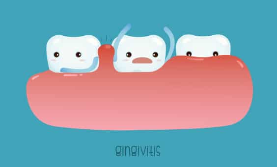 everything you need to know about gingivitis