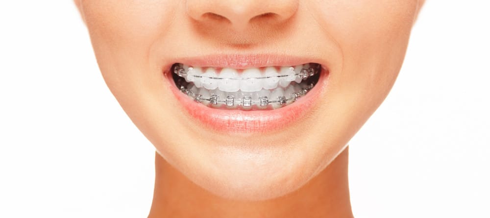 5 Tips for Keeping Your Mouth Healthy When Wearing Braces