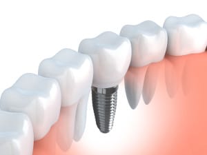 dental implants faq