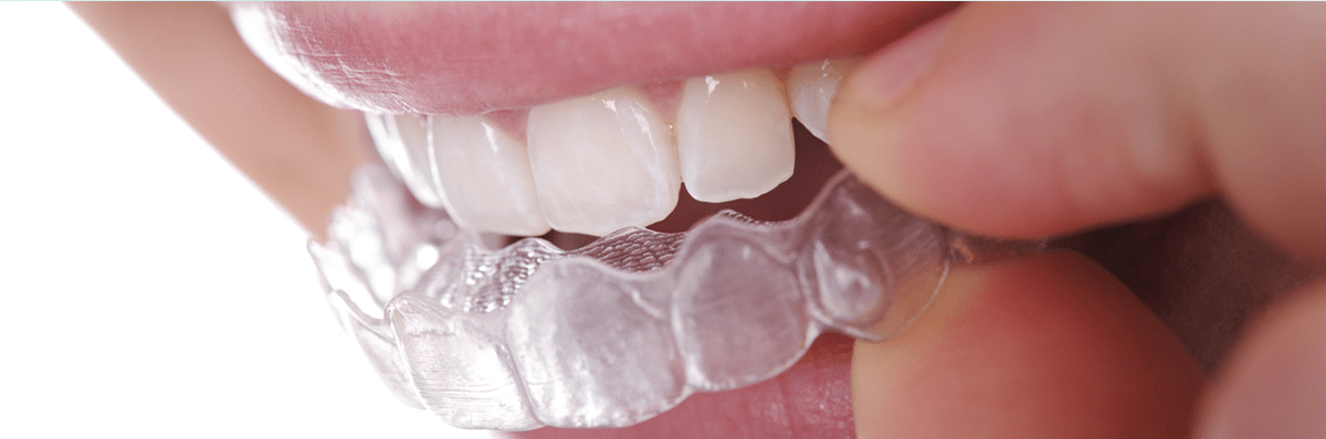 Invisalign