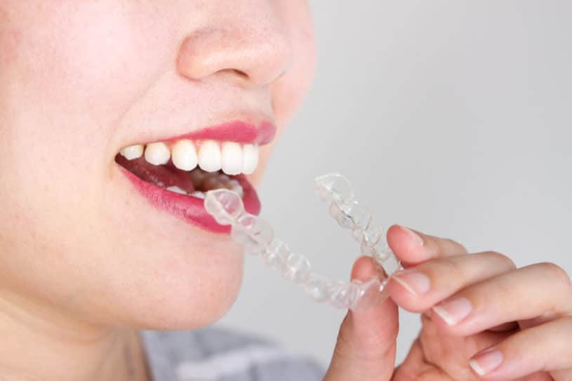 Invisalign Teeth Alignment FAQs - The Teal Umbrella