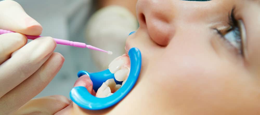 cases when you may receive dental sealants