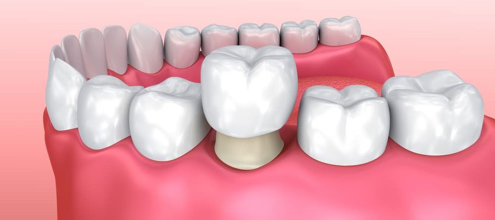 Crowns vs. Bridges vs. Dental Implants - Which Is for Me?