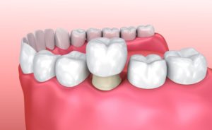 Crowns vs Bridges vs Dental Implants
