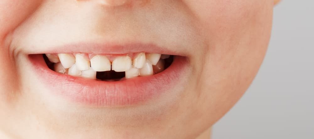 Why Doesn’t Everyone Lose Their Baby Teeth?