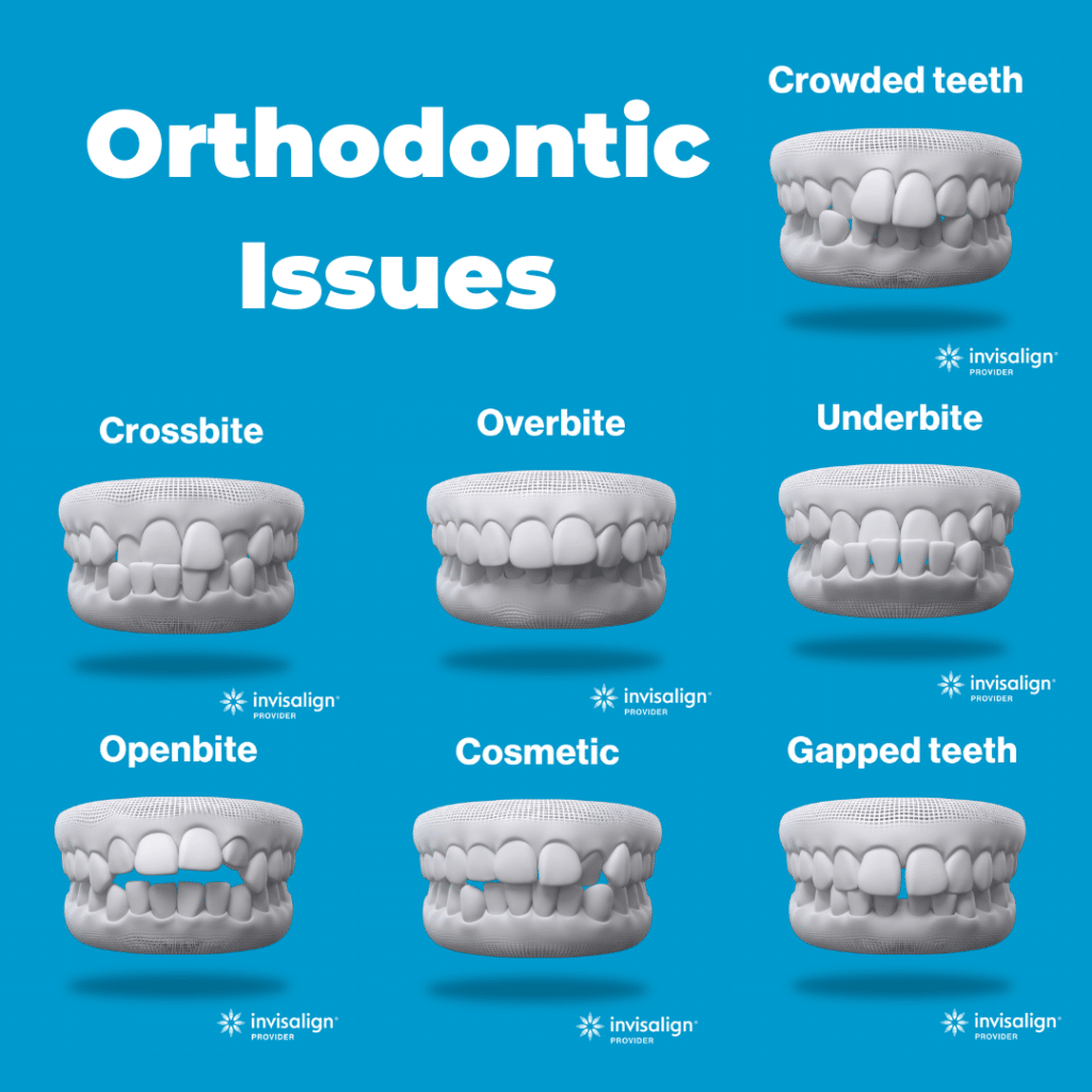 The Teal Umbrella - Before and After Invisalign,Invisalign before and after results