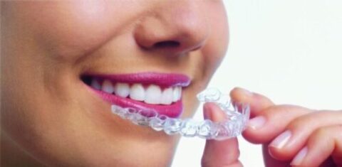 Invisalign Ottawa