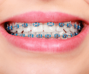 Braces in Ottawa