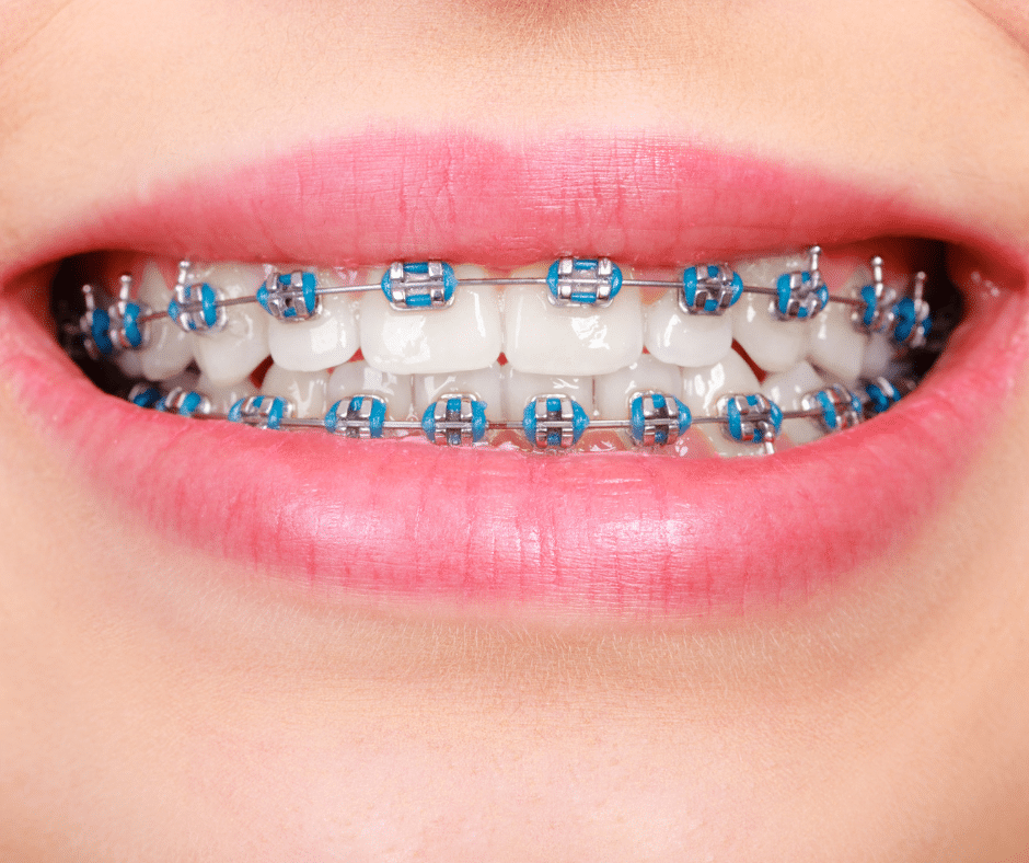 Braces