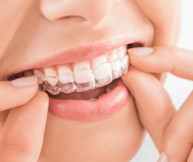 Woman inserting Invisalign in Ottawa
