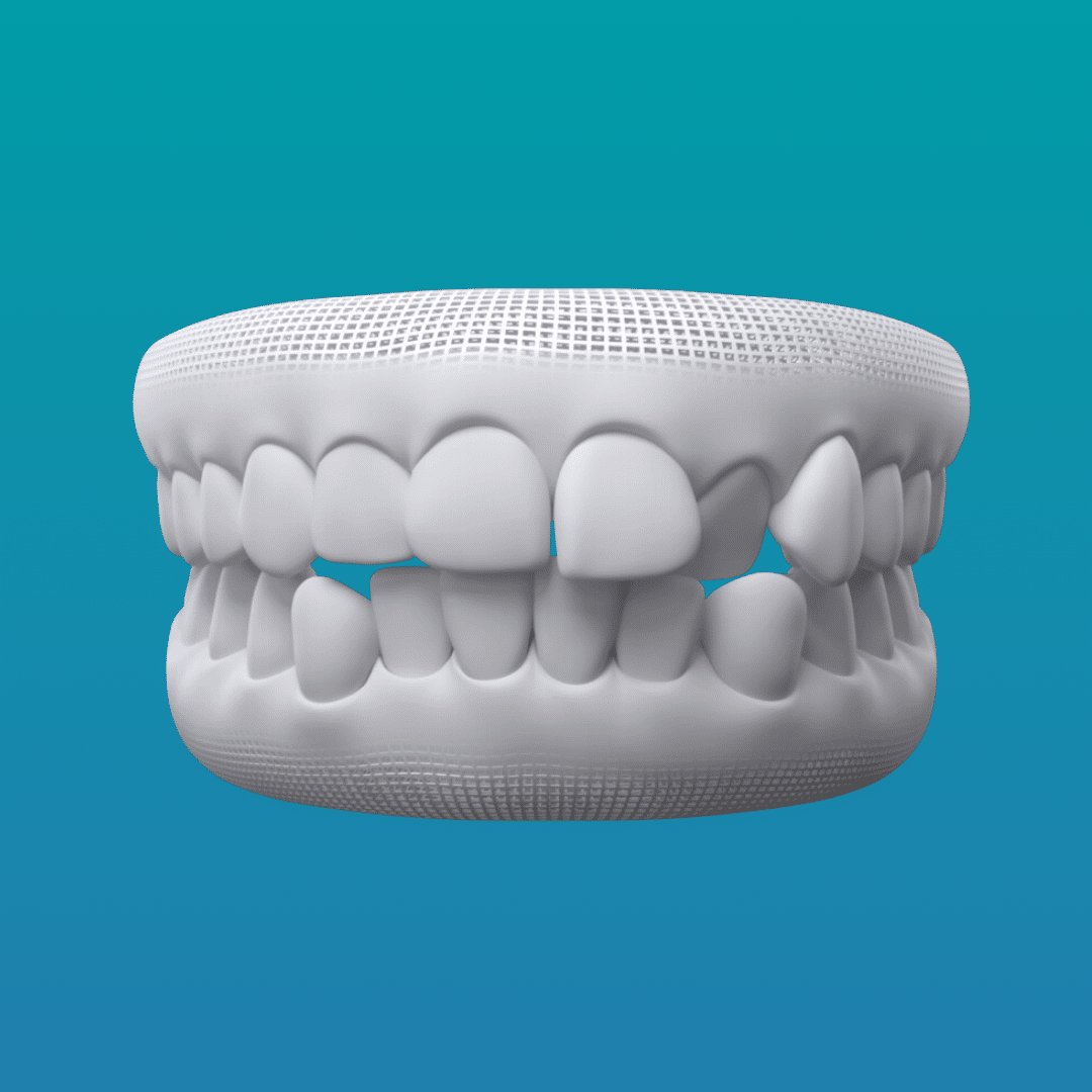 Misaligned Teeth