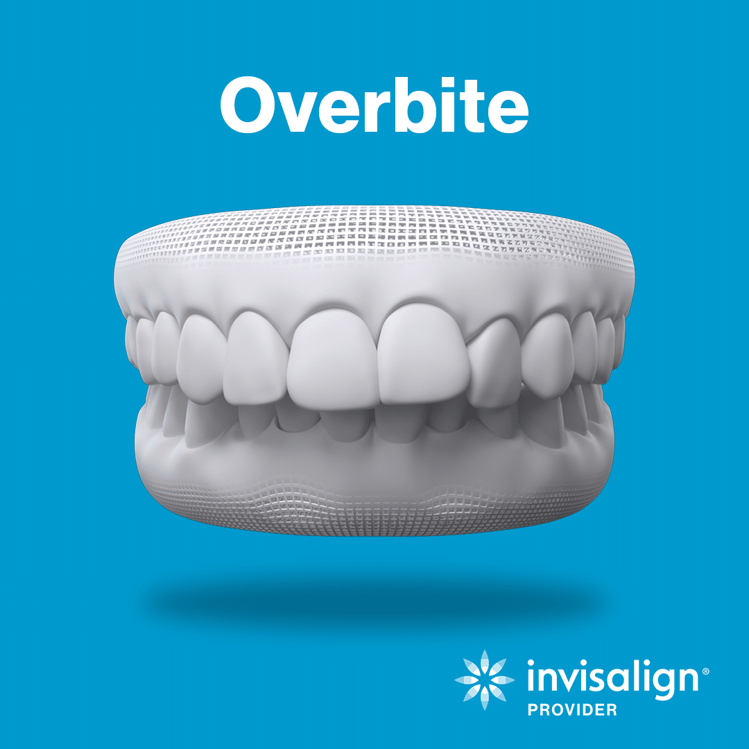 Overbite