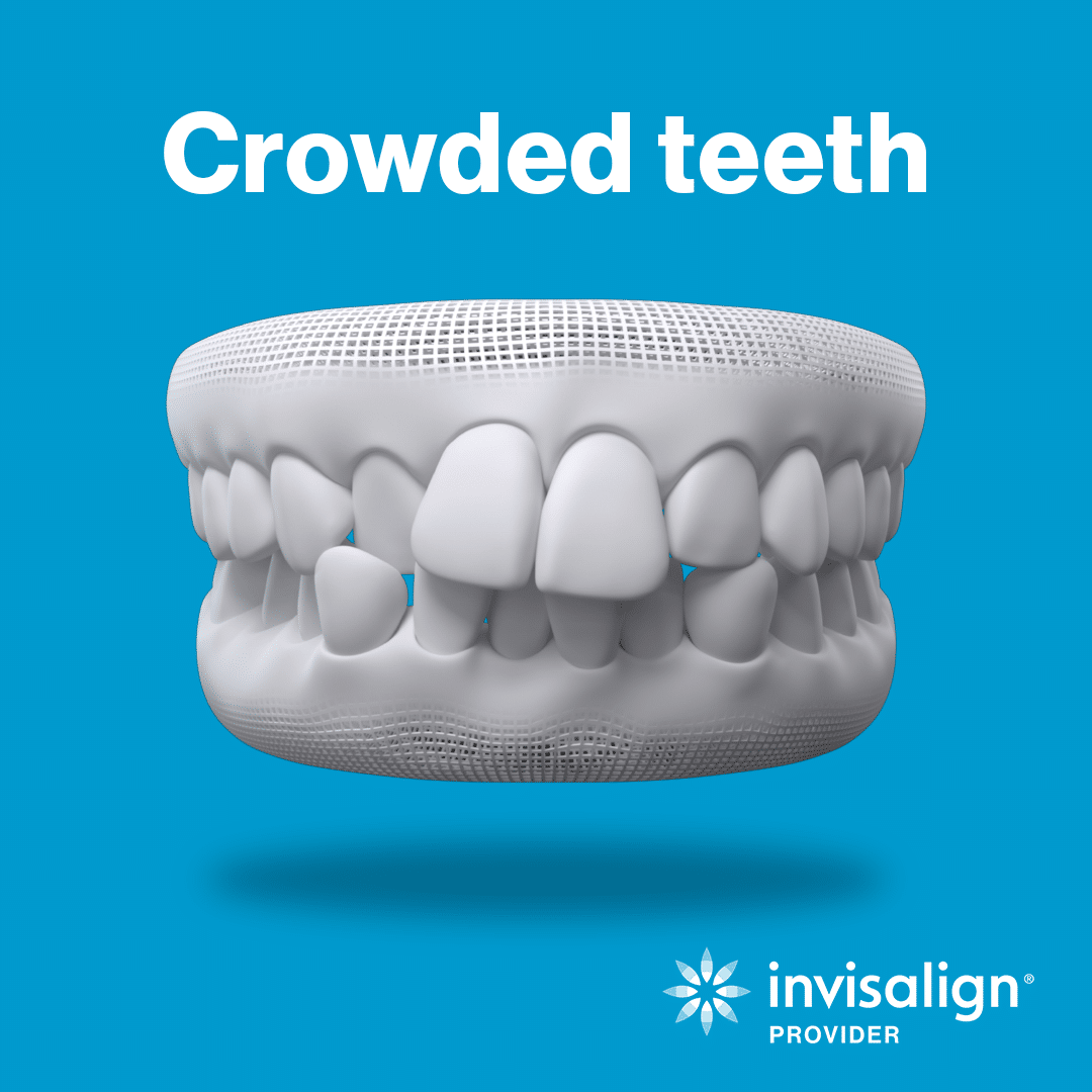 Crowded Teeth