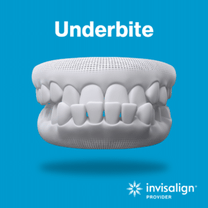 underbite