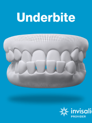 underbite