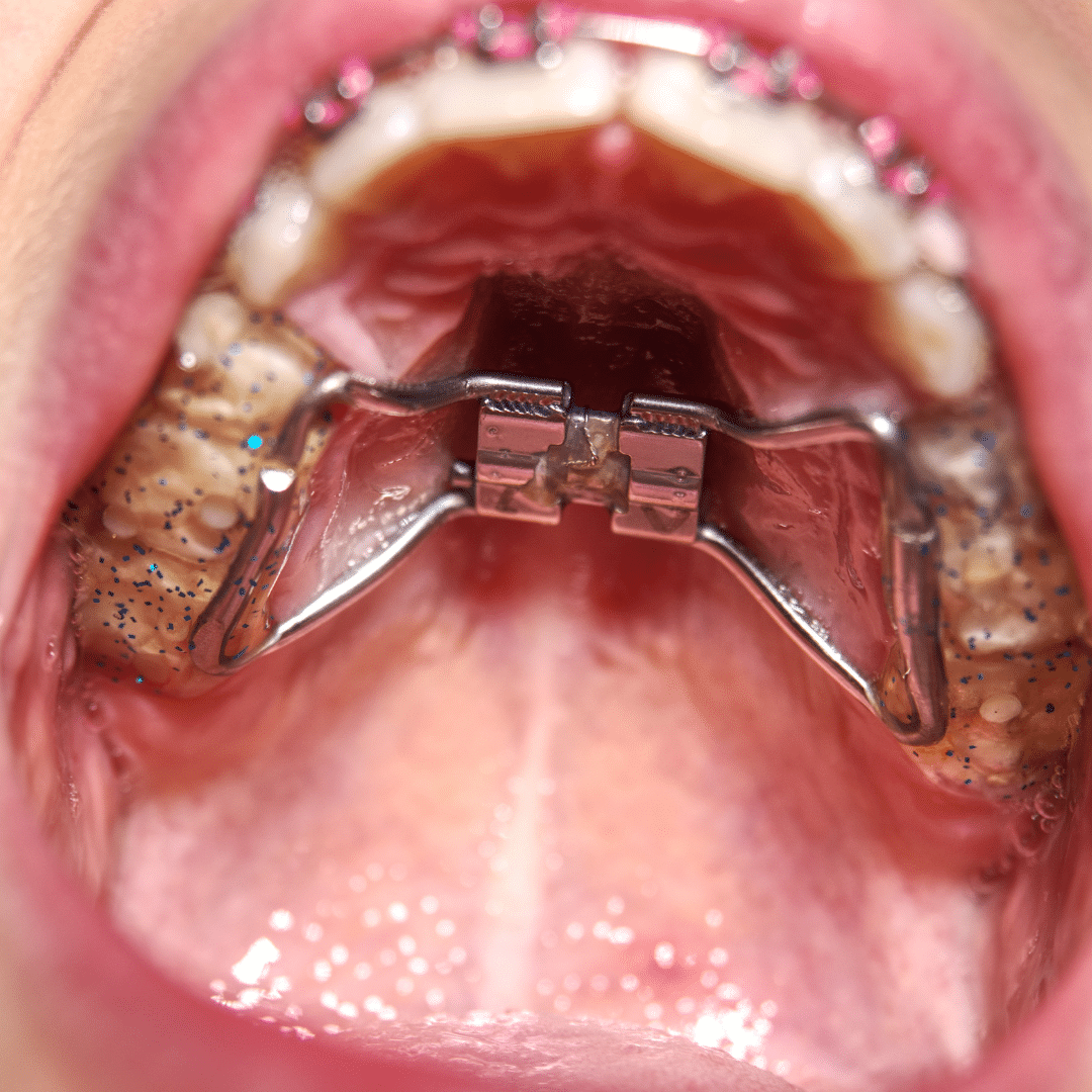 Traditional Palatal Expanders