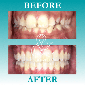 Before and After Invisalign - The Teal Umbrella - Before and After Invisalign,Invisalign before and after results Before and after invisalign