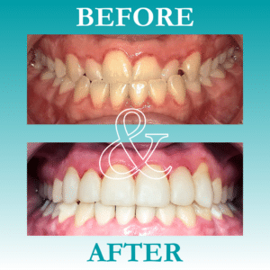 Before and After Invisalign - The Teal Umbrella - Before and After Invisalign,Invisalign before and after results Before and after invisalign