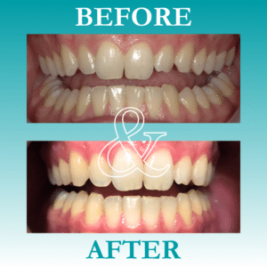 Before and After Invisalign - The Teal Umbrella - Before and After Invisalign,Invisalign before and after results Before and after invisalign