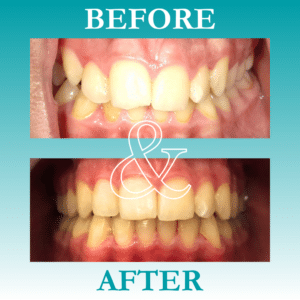 Before and After Invisalign - The Teal Umbrella - Before and After Invisalign,Invisalign before and after results Before and after invisalign