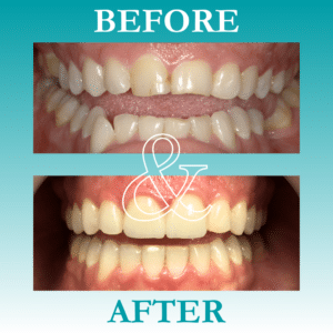 Before and After Invisalign - The Teal Umbrella - Before and After Invisalign,Invisalign before and after results Before and after invisalign