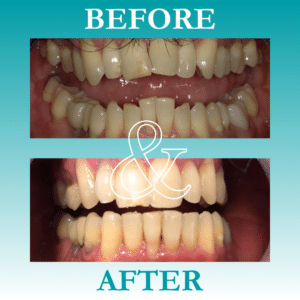 Before and After Invisalign - The Teal Umbrella - Before and After Invisalign,Invisalign before and after results Before and after invisalign