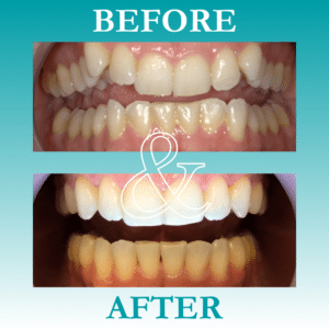 Before and After Invisalign - The Teal Umbrella - Before and After Invisalign,Invisalign before and after results Before and after invisalign