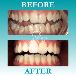 Before and After Invisalign - The Teal Umbrella - Before and After Invisalign,Invisalign before and after results Before and after invisalign
