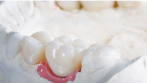 Porcelain Crowns Bridges