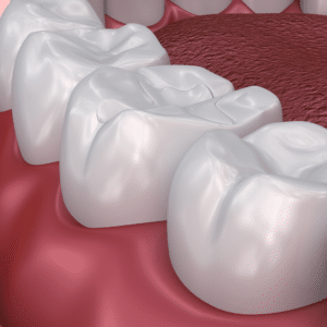 Cases When You May Receive Dental Sealants - The Teal Umbrella - When You May Receive Dental Sealants cases when you may receive dental sealants