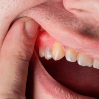 Swollen or tender gums near the affected tooth