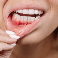 A recurring pimple on the gums