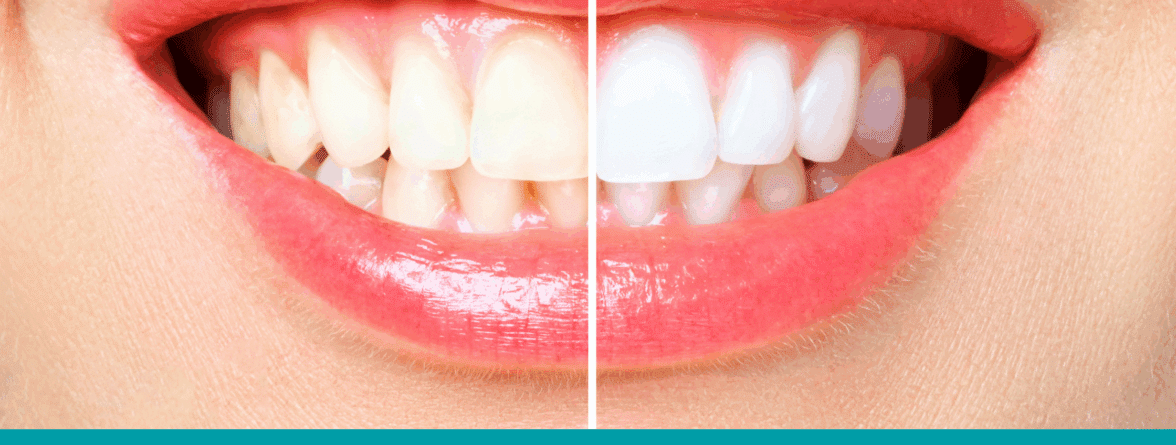 - teeth whitening Ottawa