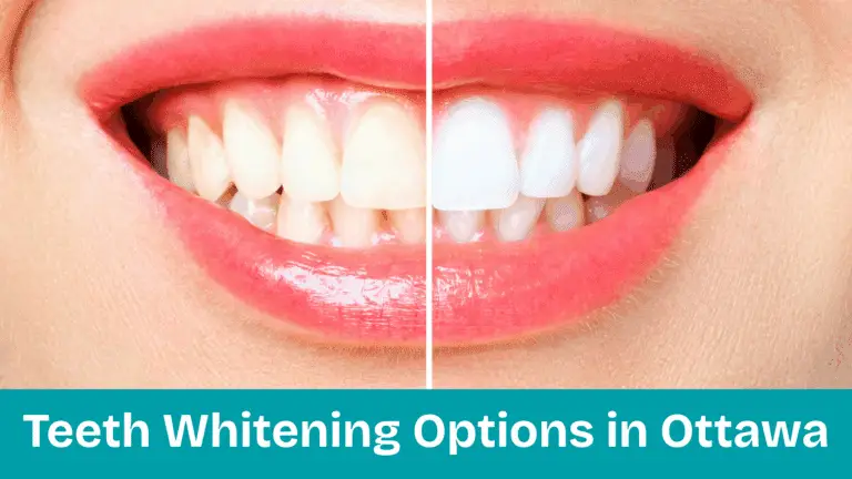 Teeth Whitening Options in Ottawa—At-Home vs. In-Office